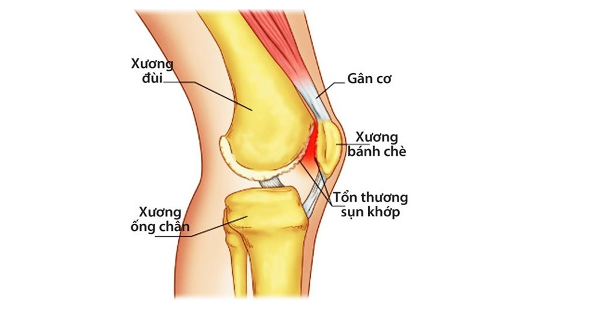dau khớp gối