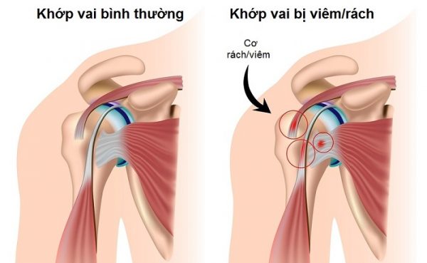 h.2-hoi-chung-chop-xoay-vai