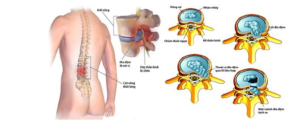 thoat vị dia dem
